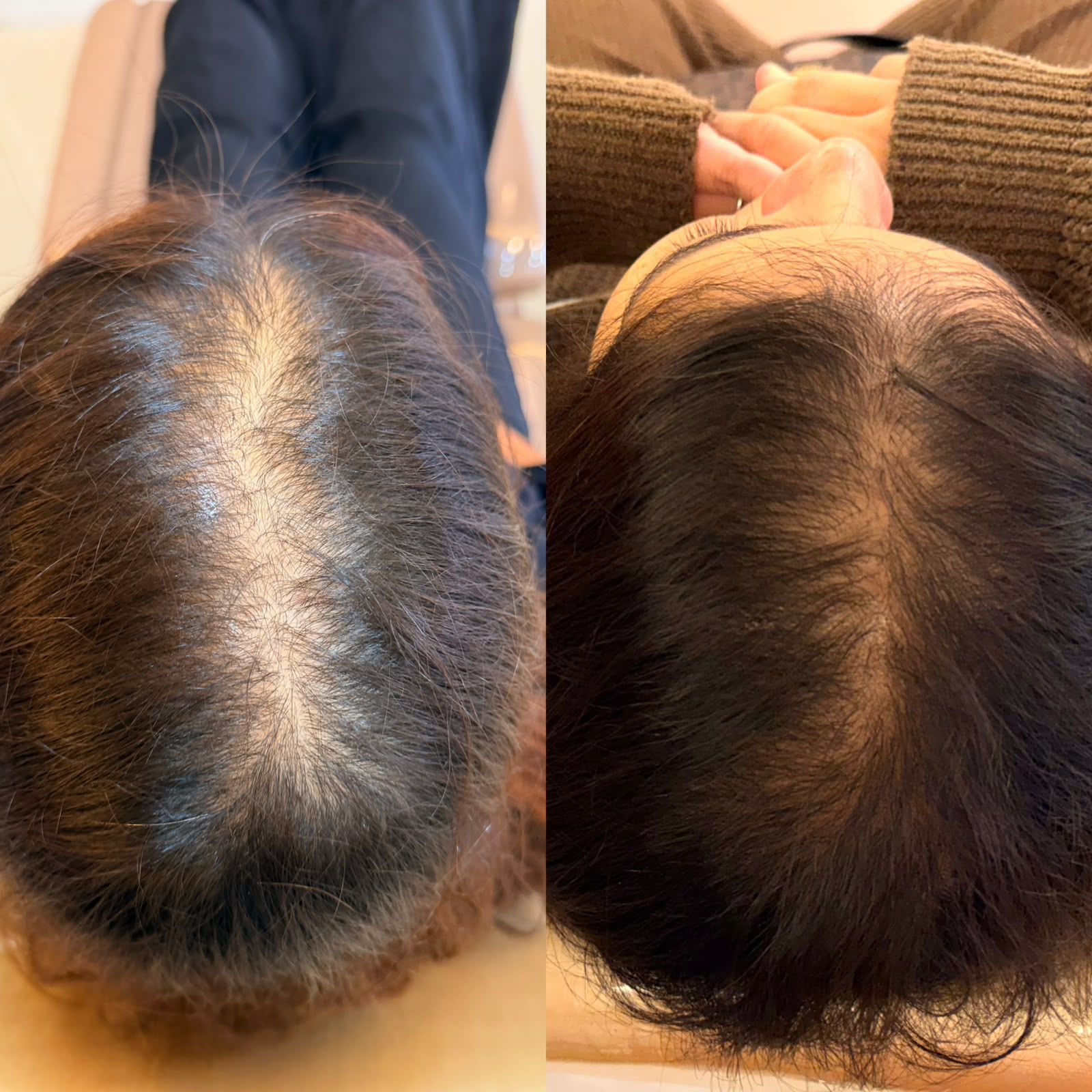 Antes e depois de alopecia androgenética feminina