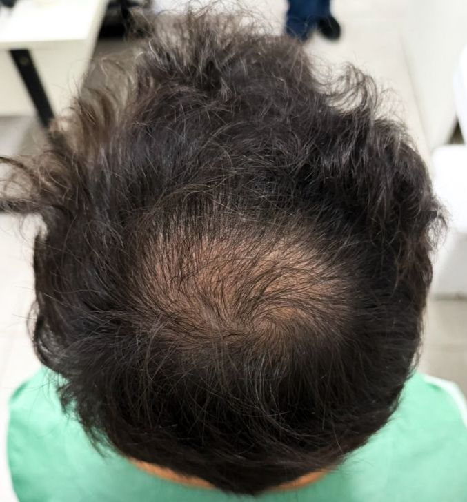 Antes do tratamento de queda de cabelo masculina