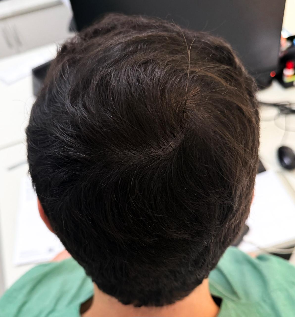 Depois do tratamento de queda de cabelo masculina