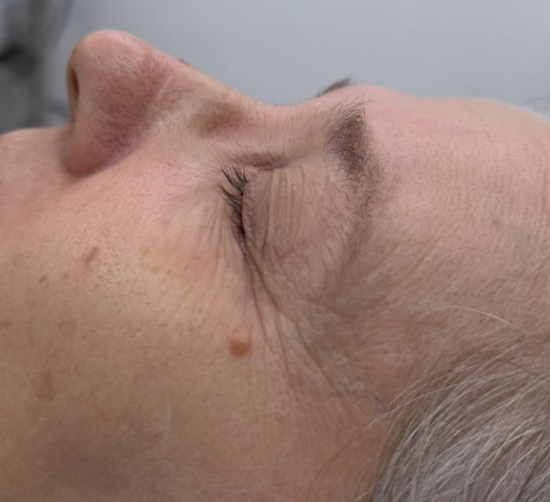 Antes - blefaroplastia