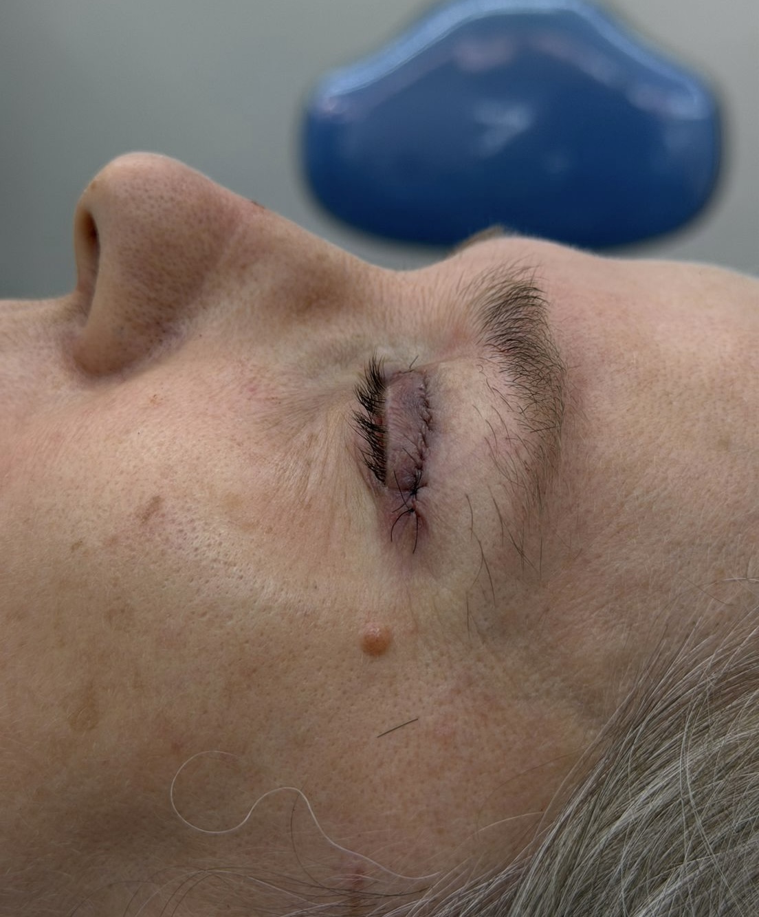 Depois - blefaroplastia