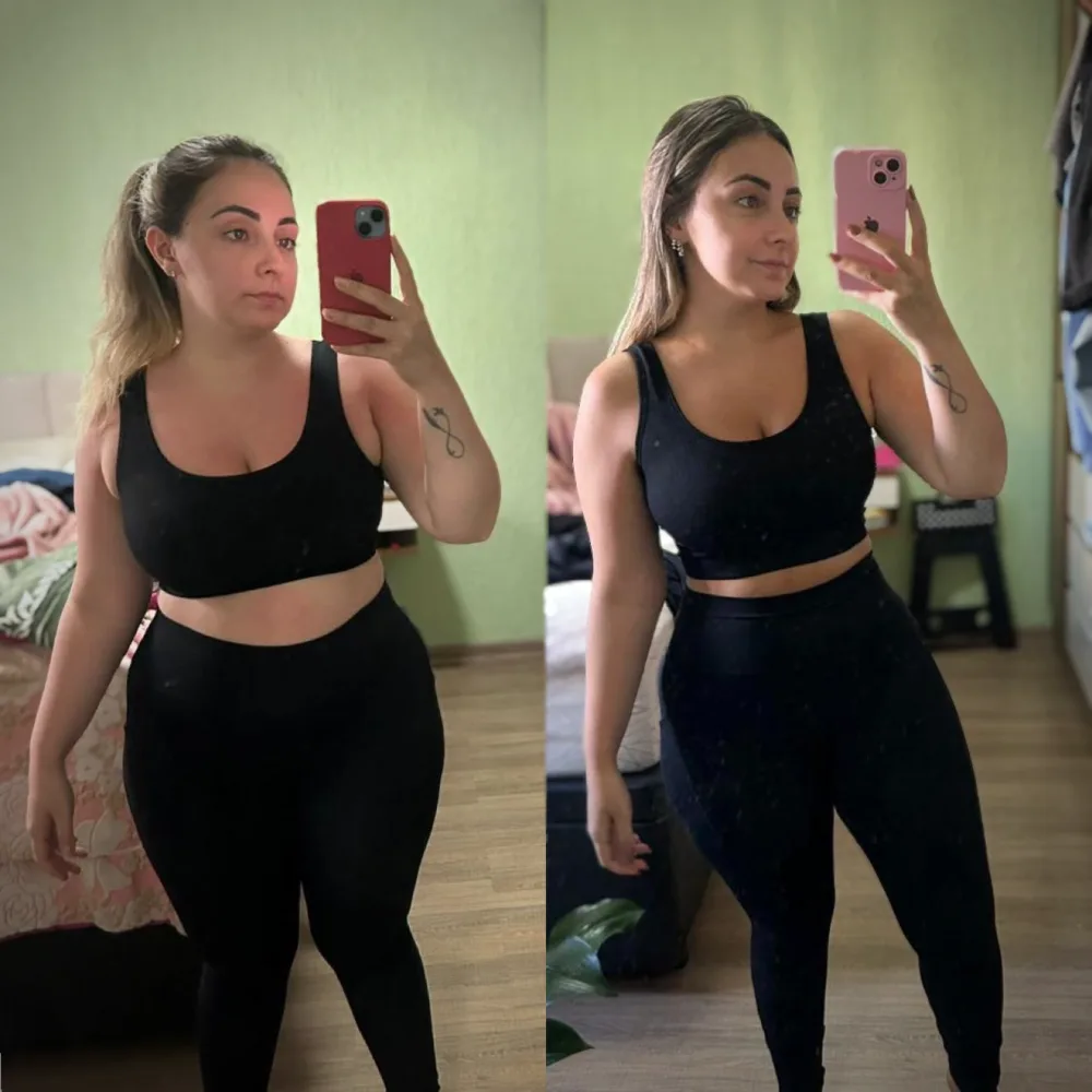 Antes e depois de emagrecimento, paciente acompanhado por Lucas Peralles em Tatuapé