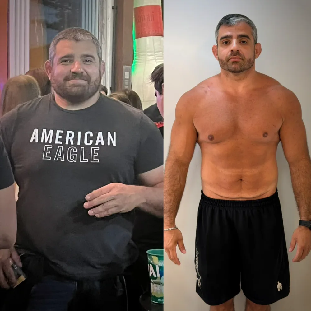 Antes e depois de emagrecimento, paciente acompanhado por Lucas Peralles em Tatuapé