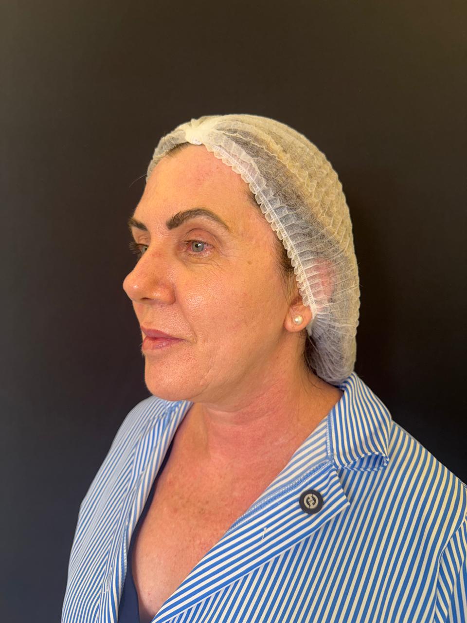 Depois - flacidez facial