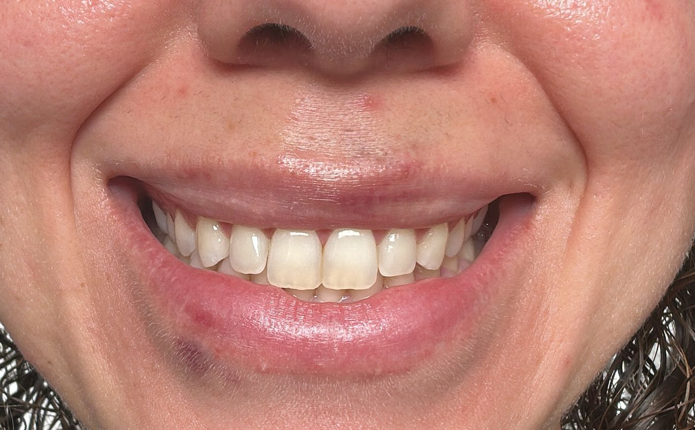 Depois - sorriso gengival